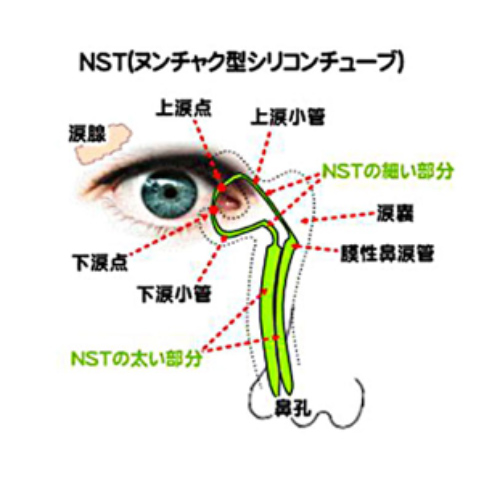 涙道内視鏡検査・シリコンチューブ留置